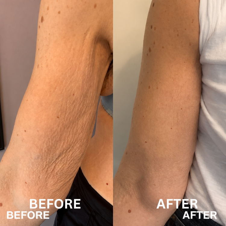 Bee Cream Arm